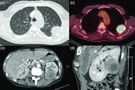 The most common area affected is the lining of the lungs and chest wall. A Ct Chest Showing Pleural Based Left Upper Lobe Lung Mass B Pet Download Scientific Diagram