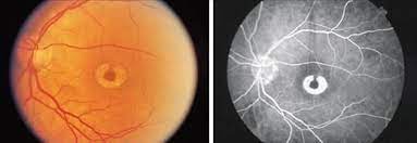 Pin On Eye Health