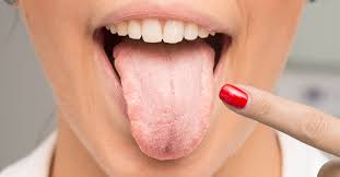 تعرف على حساسية اللسان والتهابه ويب طب