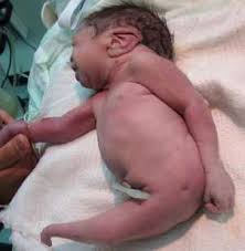 Image result for deformed babies in Iraq caused by depleted uranium