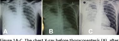 Pleural effusion is an accumulation of fluid in the pleural cavity between the lining of the lungs and the thoracic cavity (i.e., the visceral and parietal pleurae). Pdf Intrapleural Streptokinase For Tuberculosis Loculated Pleural Effusion Semantic Scholar