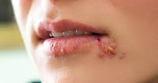 How To Treat Cold Sores With Natural Products You Will Be Amazed With The Results Healthy Tips Network Canker Sore Cold Sores Remedies Cold Sore