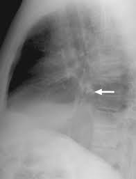 Image result for Broncholithiasis