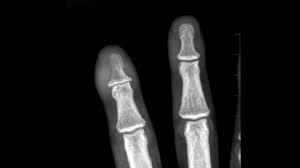 Image result for Osteomyelitis XRay
