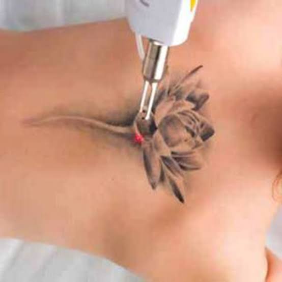 What Makes a Trusted Destination for Laser Tattoo Removal