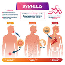 Image result for syphilis symptoms