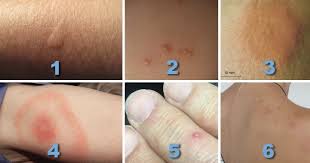 Die mitte scheint oft weißlich mit rotem rand. So Erkennst Du Anhand Vom Stich Biss Welches Insekt Dich Gestochen Gebissen Hat Und Was Du Tun Solltest