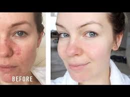 What are side effects of ivermectin. How I Cured My Rosacea Irritation Redness My Story Youtube
