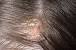 Oily Scalp