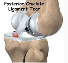 Image result for PCL Sulcus Test