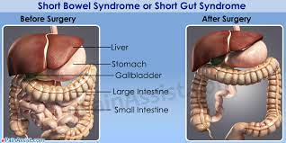 Short Bowel Syndrome Or Short Gut Syndrome Treatment Causes Symptoms