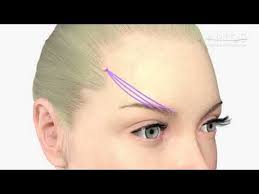 Looking for a good deal on eyebrow lift? Revolutionary Aptos Threads Face Neck Nose Brow Lifts Sydney Wahroonga Melbourne Perth Laser Skin Treatment Laser Acne Treatment Brow Lift