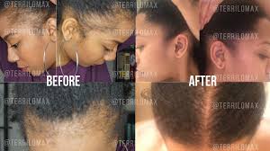 Feel like a celebrity once again! How A Hair Transplant Can Reverse Traction Alopecia And Thinning Edges