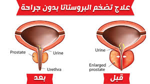 هام للرجال ، إحتقان البروستاتا ، لكل من يعاني من مشاكل في البول أو التحكم فيه. Ø¥ØºÙˆØ§Ø¡ Ø´Ø¬Ø±Ø© ØªÙˆØªØ´ÙŠ Ø§Ù„Ø¯Ù„Ø§Ù„Ø© ØªØ¶Ø®Ù… Ø§Ù„Ø¨Ø±ÙˆØ³ØªØ§ØªØ§ ÙÙŠ Ø§Ù„Ø±Ø¬Ø§Ù„ Ortonaforrunners It