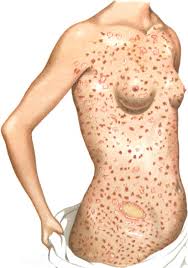 The patches get better, but leave behind areas that are lighter than the rest of your skin. File An Introduction To Dermatology 1905 Pityriasis Rosea Jpg Wikimedia Commons