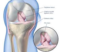 The acl (anterior cruciate ligament) is a band of tissue inside your knee. Knee Injuries And Knee Reconstruction Dr Jerry Van De Pol Orthopaedic Surgeon