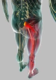 Wttc World Top Trainers Certification Sciatica And Piriformis Syndrome A Positive Relationship