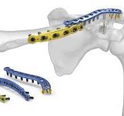 Clavicle Plating System | Acumed