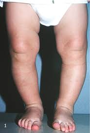 Image result for Pediatric Leg Disorder