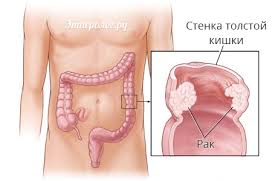 Rak Kishechnika Stadii Simptomy Techenie Zabolevaniya Osobennosti Lecheniya Opuholi Prognozy I Rekomendacii