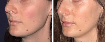 Serdev Sutures in Middle Face