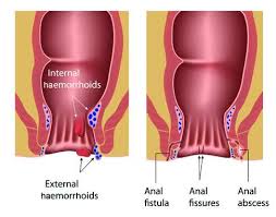 Maybe you would like to learn more about one of these? Mistakes In Managing Perianal Disease And How To Avoid Them Ueg United European Gastroenterology