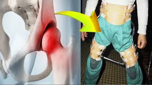 The osteochondroses typically are characterized by degeneration and subsequent regeneration of the. What Is Perthes Disease Wellness And Health Webmediums