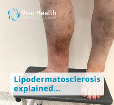 Image result for Lipodermatosclerosis