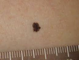 Unlike other types of lentigo, lentigo simplex isn't caused by skin damage. Lentigo Images Dermnet Nz