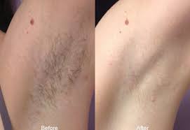 Other rare side effects include graying of treated. Laser Hair Removal In Oshawa Harmony Medspa