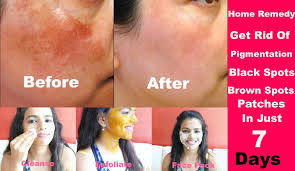 How To Remove Black Spots And Dark Spots On Face Remove Pigmentation Get Flawless Face In 7 Day Pigmentation Treatment Skin Care Pimples Dark Spots On Face