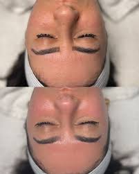 I'm obsessed with this acne transformation! Not only did we control her  acne but LOOK at the reduction of texture! 💬How did we achieve this? A  customized @facerealityskincare regimen, 4 in-office acne