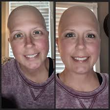 Embracing baldness and alopecia