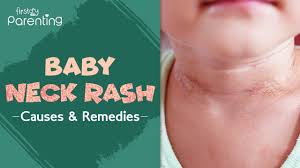 For a better experience on crest.com, please enable javascript in your browser. Neck Rash In Babies Causes Signs And Treatment Youtube