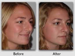 Miami Institute Before And After Photo Galleries Cosmetic Surgery Nose Plastic Surgery Rhinoplasty