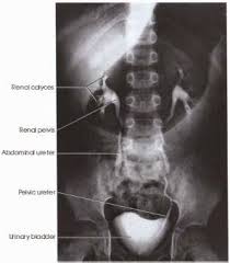 Image result for Intravenous Pyelogram