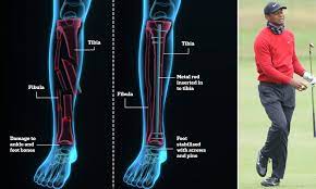 While a few medical professionals think his prognosis looks good, some think his outcome is up in the air. Tiger Woods Crash Golfer S Career In Doubt As He Shatters Right Leg Daily Mail Online