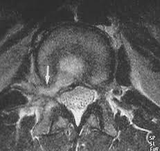Image result for Low Back Imaging