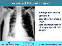 Local Pleural Effusion In 2020 Pleural Effusion X Ray Interpretation