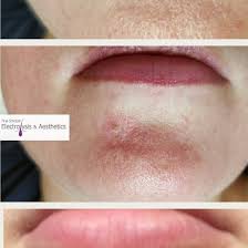 It is possible there would be some mild swelling and the area can become bruised but these would be relatively short term effects. Tina Sinclair The Clinic One Cherry Angioma Gone Also Known As Campbell De Morgan Or Cherry Papules Totally Harmless Bunches Of Blood Vessels Just Under The Skin Treated In