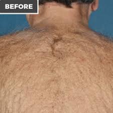 Ideal for both men and. Laser Hair Removal Laser Skin Solutions