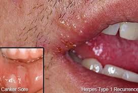 Image result for oral herpes symptoms roof of the mouth