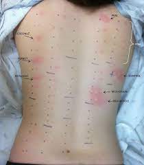About Cooking Allergy Free With Eoe