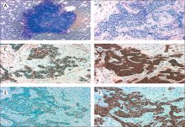 Search for mesothelioma with us. Small Cell Lung Cancer The Lancet