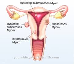 Although researchers continue to study the causes of fibroid tumors, little scientific evidence is available on how to prevent them. Myoma Tumor Rahim Sebab Gejala Rawatan Penyakit