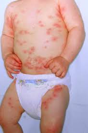 Image result for Allergic Colitis of Infancy