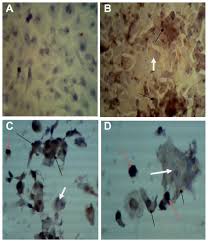Live Attenuated Measles Virus Vaccine Therapy For Locally Established Ov