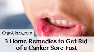3 Home Remedies To Get Rid Of A Canker Sore Fast Orawellness
