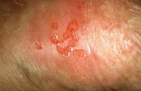 Image result for genital herpes
