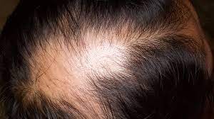 Rashes and hives can cause dog hair loss insect bites and stings, plants, chemicals, shampoos, and medications can cause rashes. How To Identify Rashes And Other Lupus Skin Symptoms Everyday Health